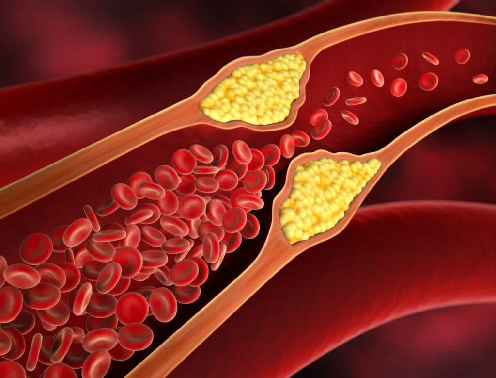 How are hypertension heart disease and stroke related