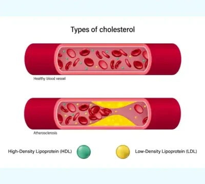 lipid-panel-test